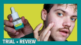 kiehls truly targeted acneclearing pimple patch  trial  review [upl. by Inami]