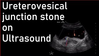 Ureterovesical junction stone on Ultrasound [upl. by Aiuqenehs]