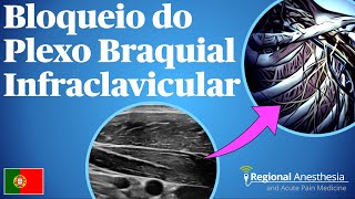 Bloqueio do Plexo Braquial Infraclavicular [upl. by Kan]