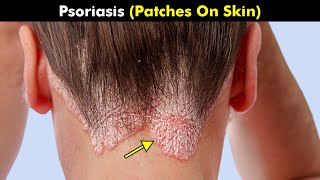 Psoriasis  Symptoms Causes And Treatment UrduHindi [upl. by Willetta]