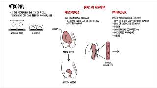 Cellular Adaptation  hyperplasia hypertrophy atrophy and metaplasia  cell injury [upl. by Schoenberg]