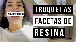 FACETAS DE RESINA  NOVO SORRISO [upl. by Enneyehs173]