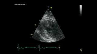 APICAL HYPERTROPHIC CARDIOMYOPATHY  ECHOCARDIOGRAPHY cardiac ultrasound [upl. by Mata453]