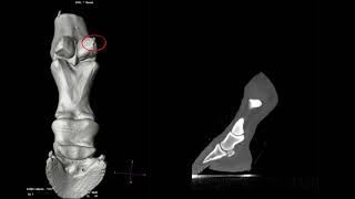 Proximal Sesamoid Fractures [upl. by Allicirp567]