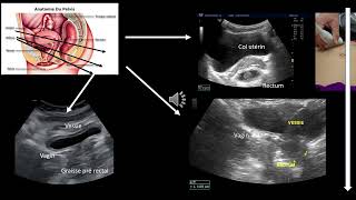 Echographie digestive visualisation du rectum Difficile [upl. by Colwell]