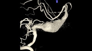 Giant cerebral basilar artery fusiform aneurysm  Edovascular treatment [upl. by Niattirb596]