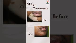 Vitiligo treatment  Cutis Hospital Bangalore  Vitiligo Before and After [upl. by Einot]