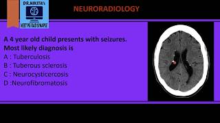 Tuberous sclerosis Neuroradiology [upl. by Timmy]