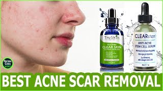 HOW TO GET RID OF ACNE SCARS FAST  BEST ACNE SCAR REMOVAL  REMOVE ACNE MARKS [upl. by Dragone614]