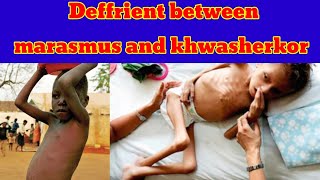 deffrient between marasmus and kwashiorkor  kwashiorkor vs marasmus pashto [upl. by Eirene]