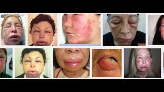 Angioedema  a medical minute [upl. by Byrle583]