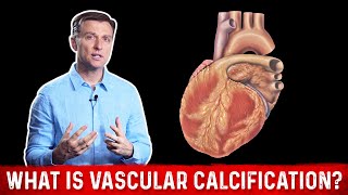 What Is Vascular Calcification – DrBerg [upl. by Eteragram861]