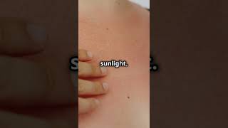 Porphyria Cutanea Tarda Skin Sensitivity to Sunlight health skincare raredisease DiagnosticLens [upl. by Yehs]