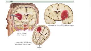 Intracerebral Hemorrhage Hemorrhagic Stroke [upl. by Marsh]