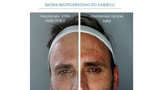 MEZOTERAPIA IGŁOWA VS MEZOTERAPIA WIELOIGŁOWA VITAL INJECTOR 2 [upl. by Htidra]