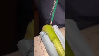 Achilles tendon repair physiotherpist surgery backpain cervicalpain comedy shorts [upl. by Assele]