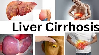 Liver CirrhosisAmharic Tutorial [upl. by Sara]