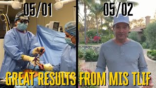 AMAZING RESULTS LESS THAN 24 HOURS AFTER A MIS TLIF Patient testimonial at the end of video [upl. by Ciapha209]