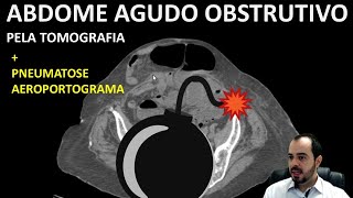 Abdome Agudo Obstrução Intestinal Mecânica por Hérnia [upl. by Linc]