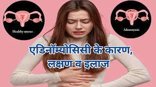 एडिनॉम्योसिस क्या होता है इसके लक्षण क्या होते है व इसके बचाव Adenomyosis Symptoms and Causes [upl. by Patience]