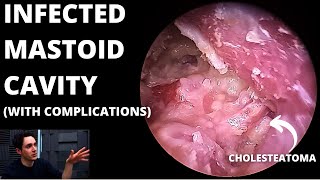 Infected Mastoid Cavity With Cholesteatoma Condylectomy May Be Needed [upl. by Gnolb433]