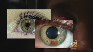 New Study Looks At Possible Relationship Between Eye Freckles And Melanoma [upl. by Garlen299]