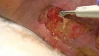 Demonstration Yellow slough removed via Qoustic Wound Therapy System [upl. by Nahtanohj]