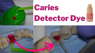 Is Caries Detector Dye BS Caries Removal investigated  PDP138 [upl. by Landsman849]