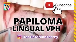 VIRUS DEL PAPILOMA HUANO VPH👅PAPILOMA LINGUAL CAUSAS [upl. by Notniv789]