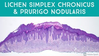 Lichen Simplex Chronicus amp Prurigo Nodularis The quotLichenquot Every Pathologist Should Know [upl. by Enniotna]