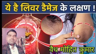 लीवर डैमेज का स्किन symptoms Acanthosis Nigricans Kya hota hai ये है लिवर डैमेज के लक्षणhealthtips [upl. by Inna]