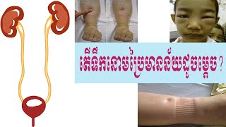 ជម្ងឺទឹកនោមប្រៃ  Nephritic Syndrome understanding [upl. by Anette212]