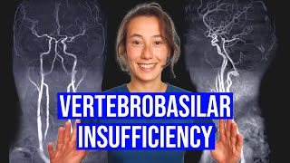 Vertebrobasilar Insufficiency VBI Test [upl. by Akehsal]