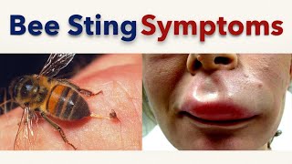 Bee Sting Symptoms [upl. by Leunamesoj643]