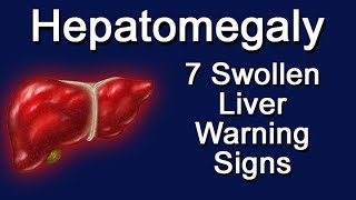 Hepatomegaly  7 Swollen Liver Warning Signs [upl. by Otiv]