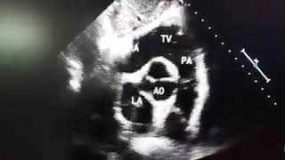 Crystal Clear Subcostal short axis view [upl. by Acnaiv]