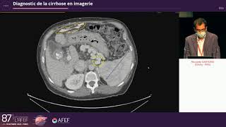 Diagnostic de la cirrhose en imagerie  R Sartoris [upl. by Attelra673]