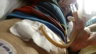 Irrigation of Indiana pouch foley after surgery [upl. by Fong711]