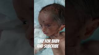 Hydrocephalus babyplz pray [upl. by Helfant]