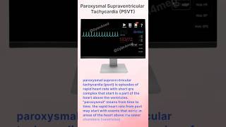 Paroxysmal Supraventricular Tachycardia PSVT [upl. by Lawton]