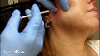 Watch Botox Facial Shaping and TMJRajani [upl. by Aivilys706]