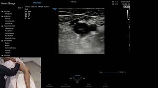 Tutorial EcoDoppler Vascular  Mapeamento do Sistema Venoso Membros Inferiores [upl. by Ahsik]