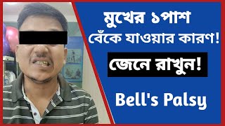 বেলস পালসি কি  বেলস পালসি বা মুখ বাঁকা হওয়ার কারণ কী মুখ বাঁকা বা বেলস পালসি bells palsy Bangla [upl. by Kerin382]