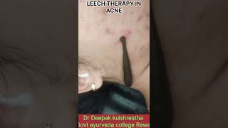 LEECH THERAPY IN ACNEAyurvedagyanseries [upl. by Suolhcin562]