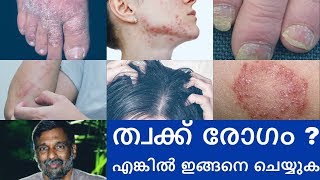 Psoriasis  Skin diseases treatment  Mohanan Vaidyar [upl. by Svoboda12]