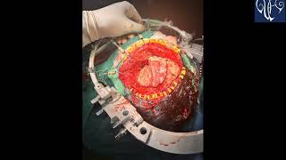 PLANUM SPHENOIDALE MENINGIOMA EXCISION  DR VIJAYMAHANTESH PUJARI [upl. by Rihat]