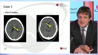 Performance of oral anticoagulants in high risk patient populations with atrial fibrillation [upl. by Irab]