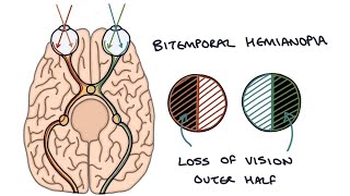 Bitemporal hemianopsia  Bitemporal Hemianopia  Drk [upl. by Rellek]