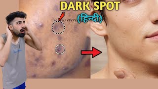 How To Remove DARK SPOTS From Face Naturally  Mridul Madhok [upl. by Remmos]