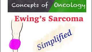 Ewing’s Sarcoma How is it different from other Sarcomas [upl. by Eah166]